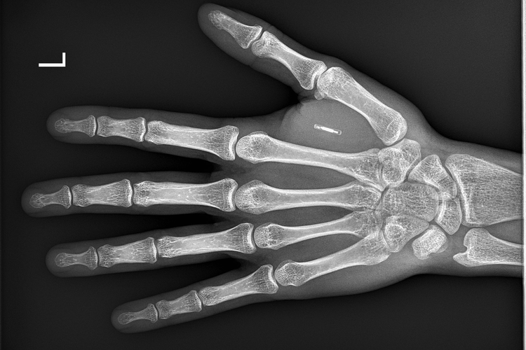Radiografía de microchip implantado RFID